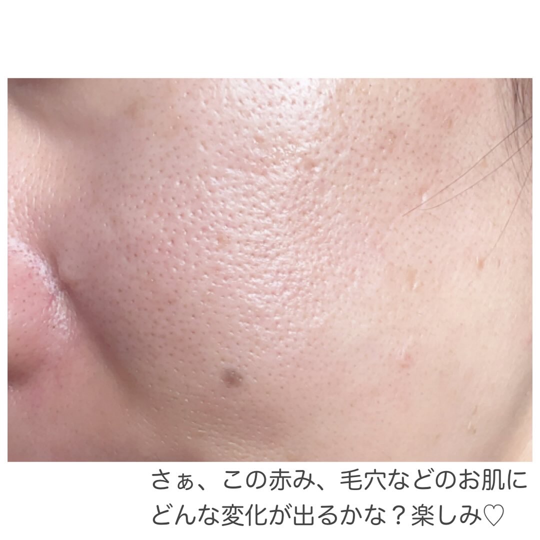 ダーマジェンシー ゼロカ86 トナー/DERMAGENCY/化粧水を使ったクチコミ（3枚目）