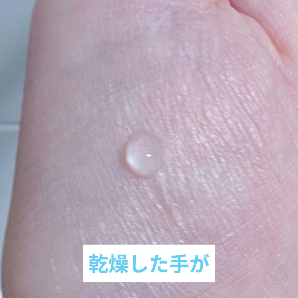 アネトス アクネケア トリートメント セラム/Anetos/美容液を使ったクチコミ（3枚目）