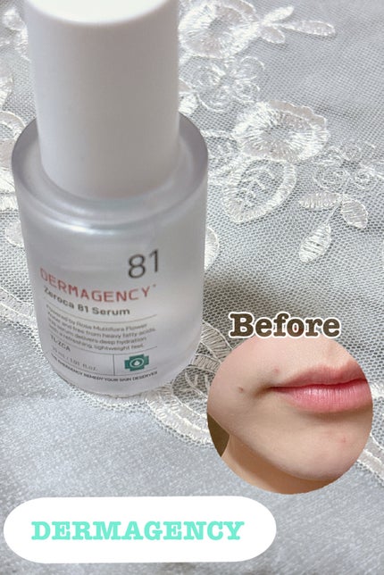 ダーマジェンシー ゼロカ81 セラム/DERMAGENCY/美容液を使ったクチコミ(1枚目)