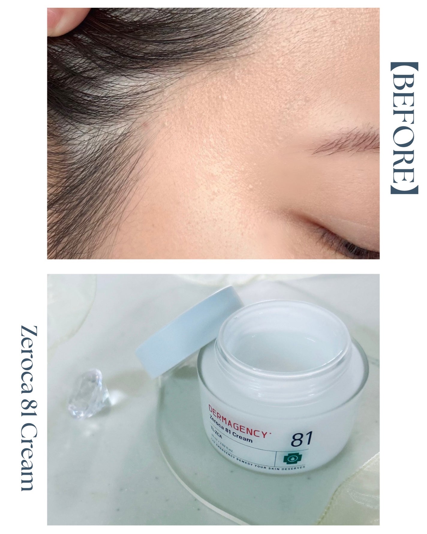 ダーマジェンシー ゼロカ81 クリーム/DERMAGENCY/フェイスクリームを使ったクチコミ(3枚目)