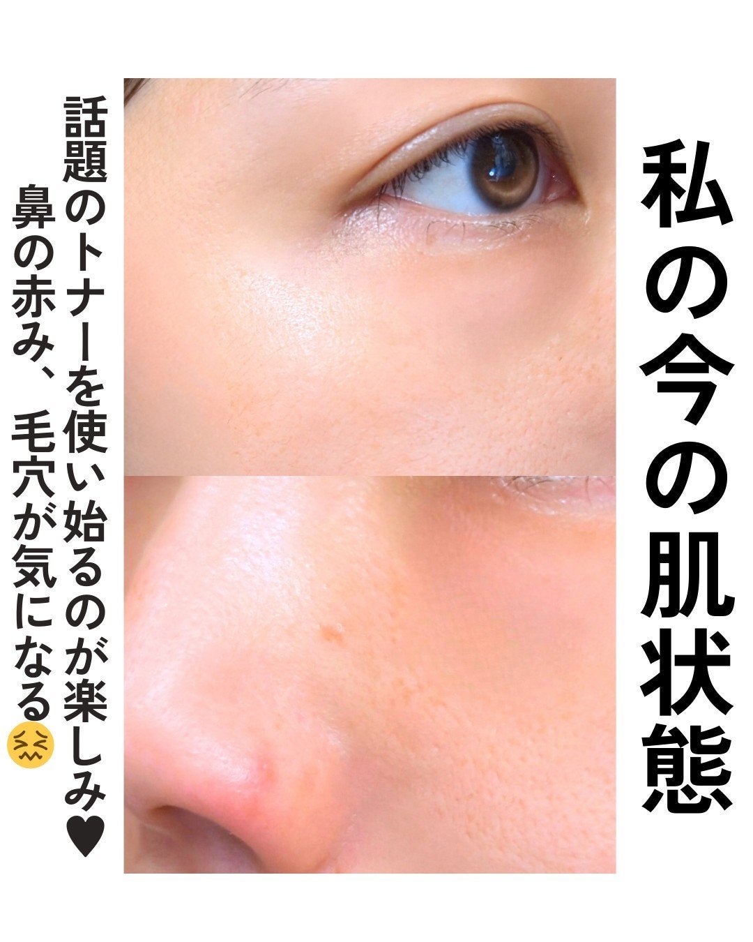ダーマジェンシー ゼロカ86 トナー/DERMAGENCY/化粧水を使ったクチコミ(3枚目)