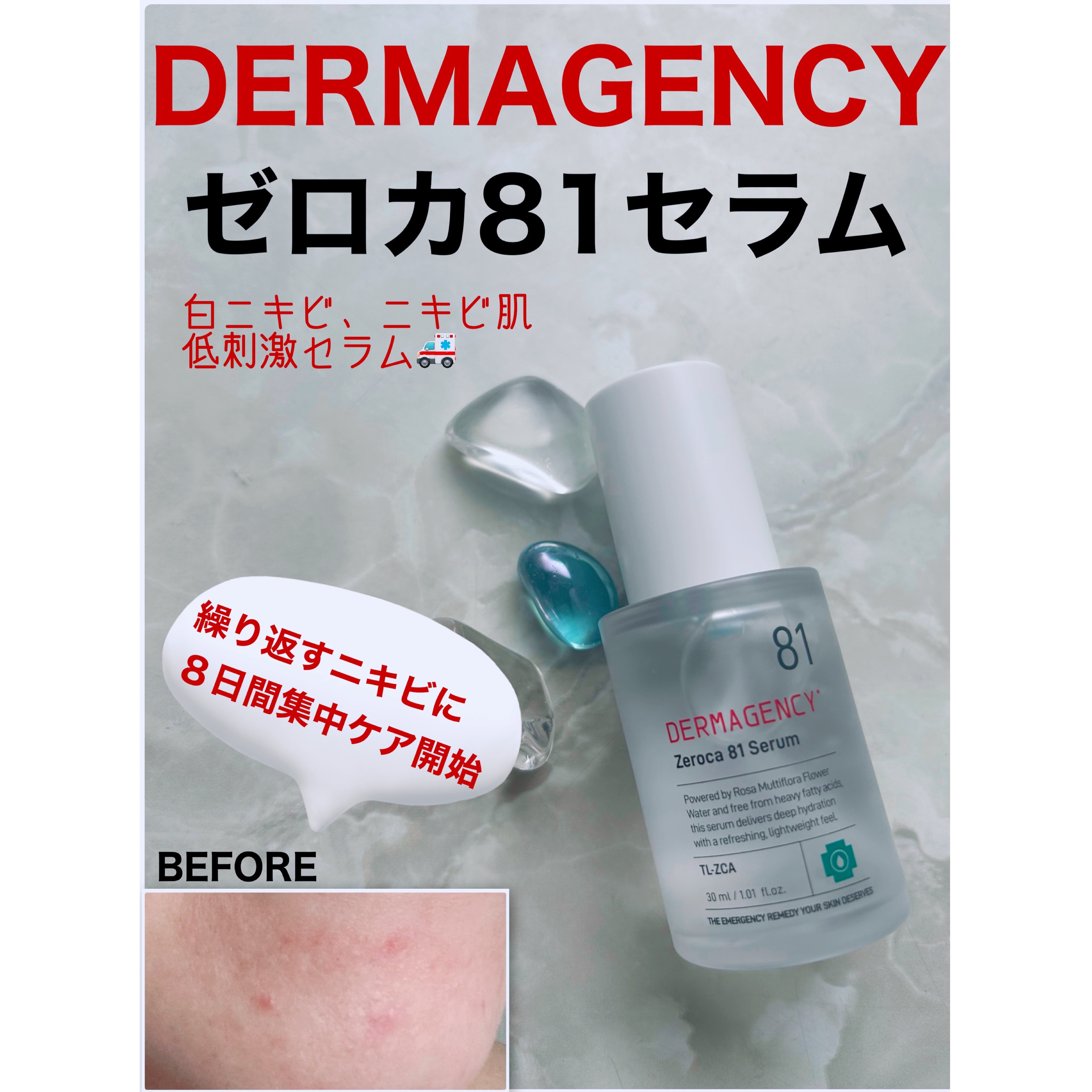ダーマジェンシー ゼロカ81 セラム/DERMAGENCY/美容液を使ったクチコミ（1枚目）