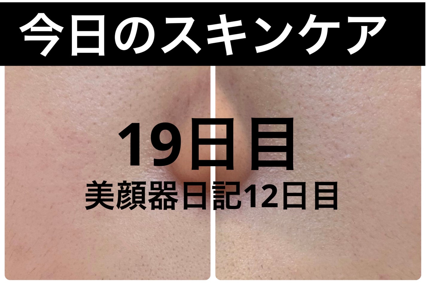 ごめんね素肌 キニナルマスク/クリアターン/シートマスク・パックを使ったクチコミ(1枚目)