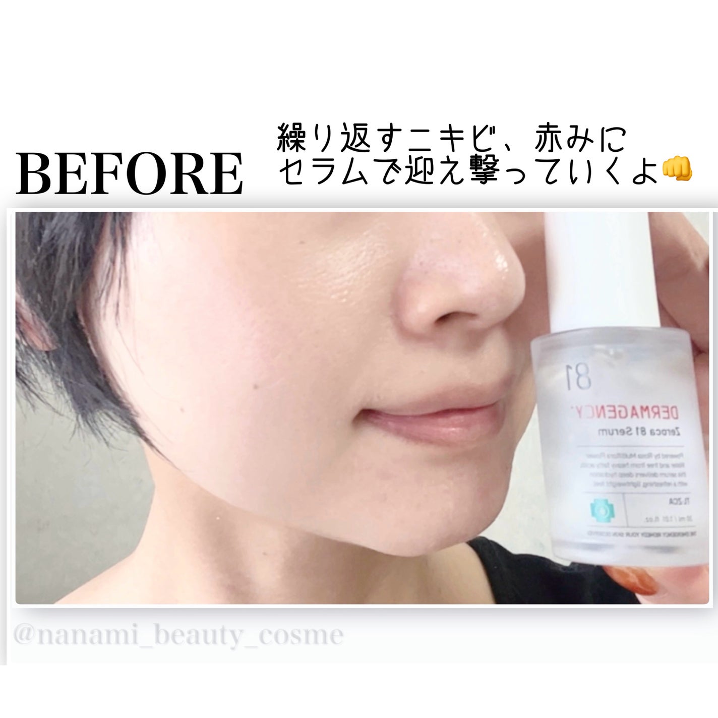 ダーマジェンシー ゼロカ81 セラム/DERMAGENCY/美容液を使ったクチコミ(4枚目)