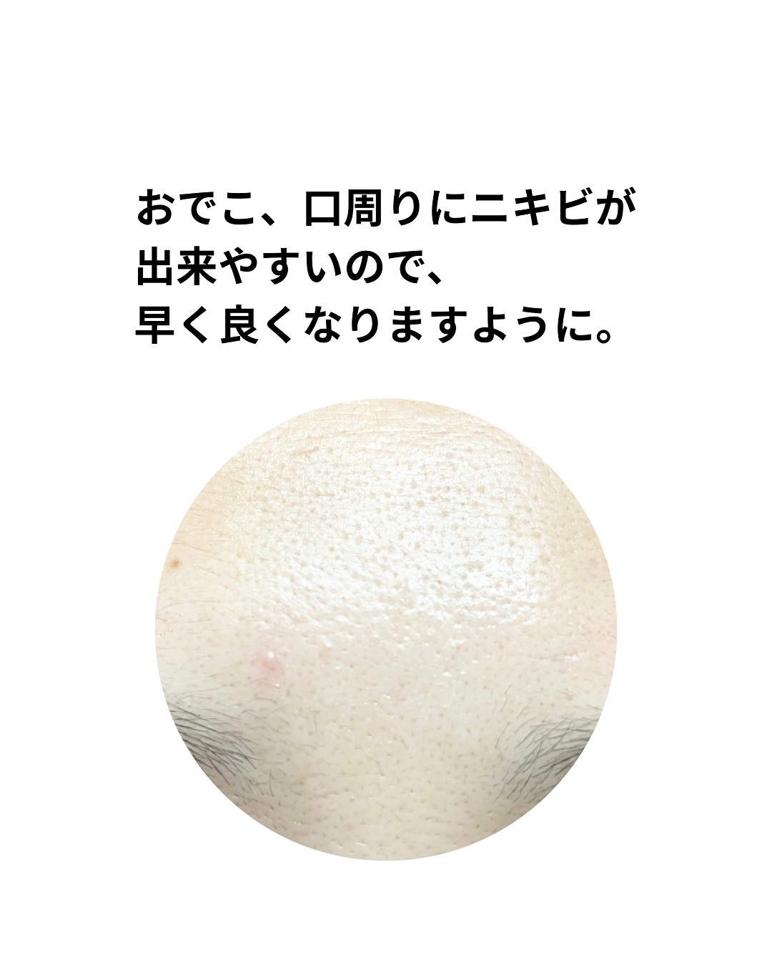 ダーマジェンシー ゼロカ81 クリーム/DERMAGENCY/フェイスクリームを使ったクチコミ（3枚目）