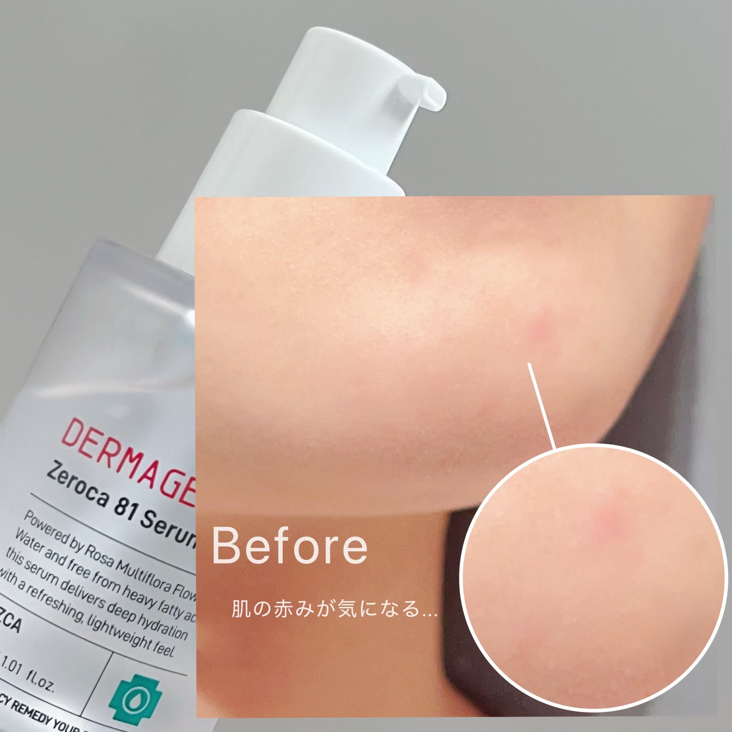 ダーマジェンシー ゼロカ81 セラム/DERMAGENCY/美容液を使ったクチコミ(3枚目)