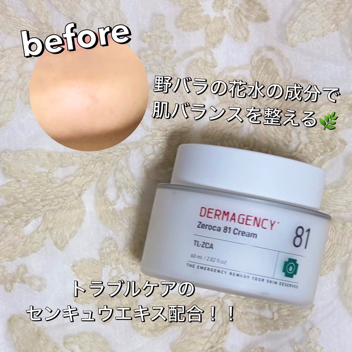 ダーマジェンシー ゼロカ81 クリーム/DERMAGENCY/フェイスクリームを使ったクチコミ（2枚目）