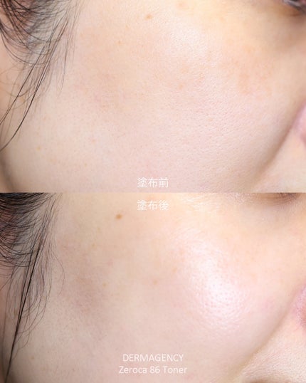 ダーマジェンシー ゼロカ86 トナー/DERMAGENCY/化粧水を使ったクチコミ(5枚目)