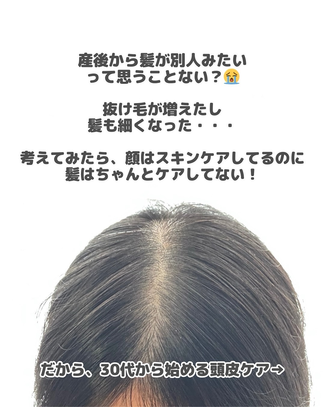 薬用育毛ローション　RANMU/RANMU/頭皮ローションを使ったクチコミ（2枚目）
