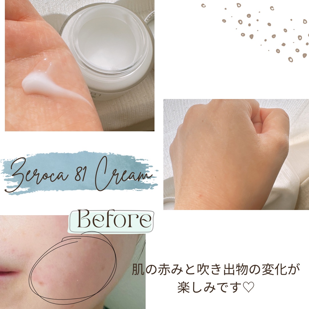 ダーマジェンシー ゼロカ81 クリーム/DERMAGENCY/フェイスクリームを使ったクチコミ（2枚目）