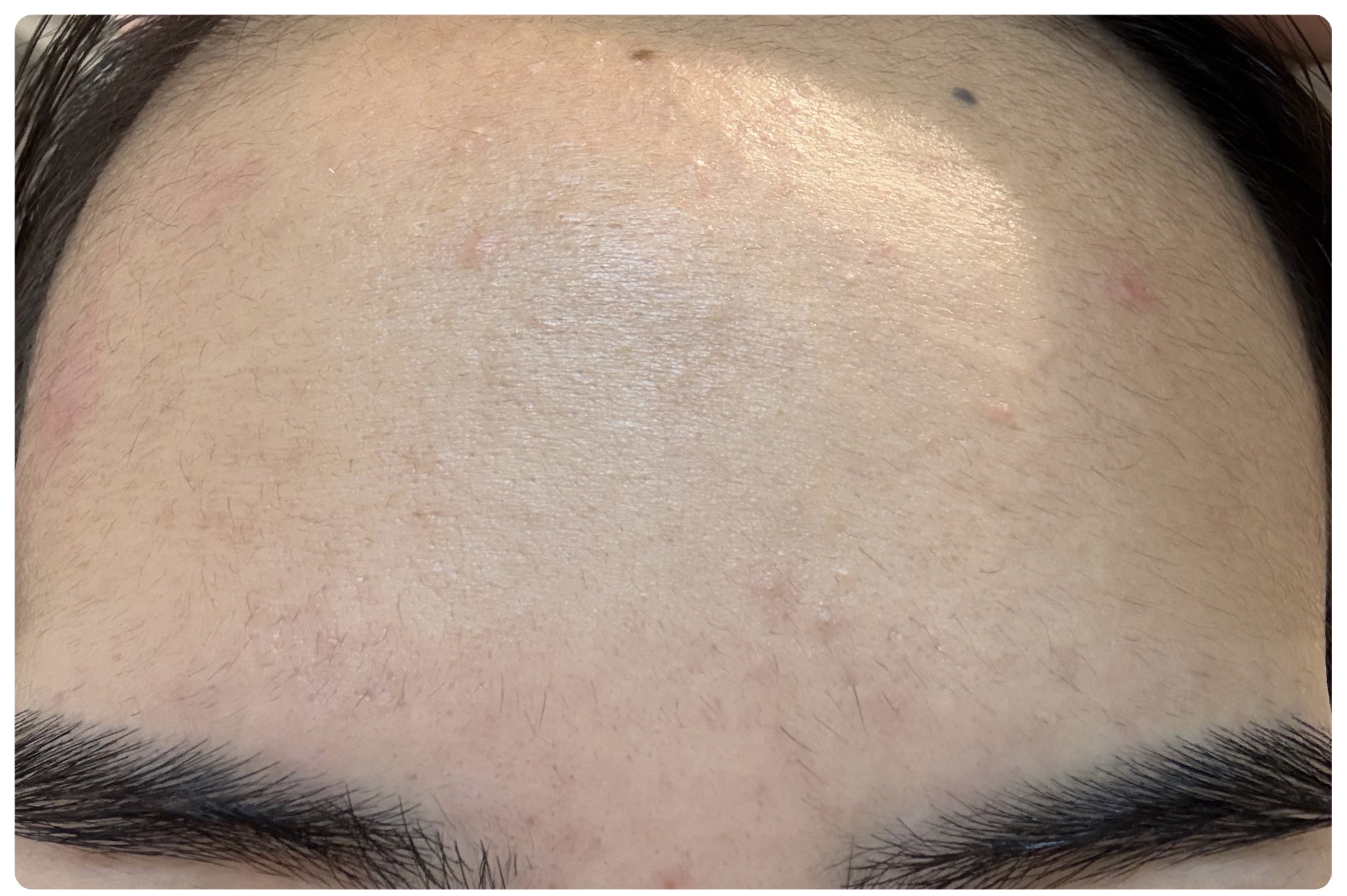 リュバンブラン エターナルアイクリームのクチコミ「【もぐもぐ日記20日目】
ニキビができないようにと注意していたにも関わらず、、、、🍪🍘🍦🍫
お.....」（3枚目）