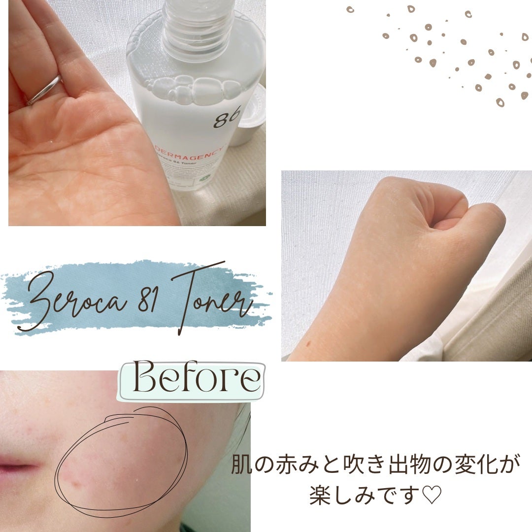 ダーマジェンシー ゼロカ86 トナー/DERMAGENCY/化粧水を使ったクチコミ(2枚目)