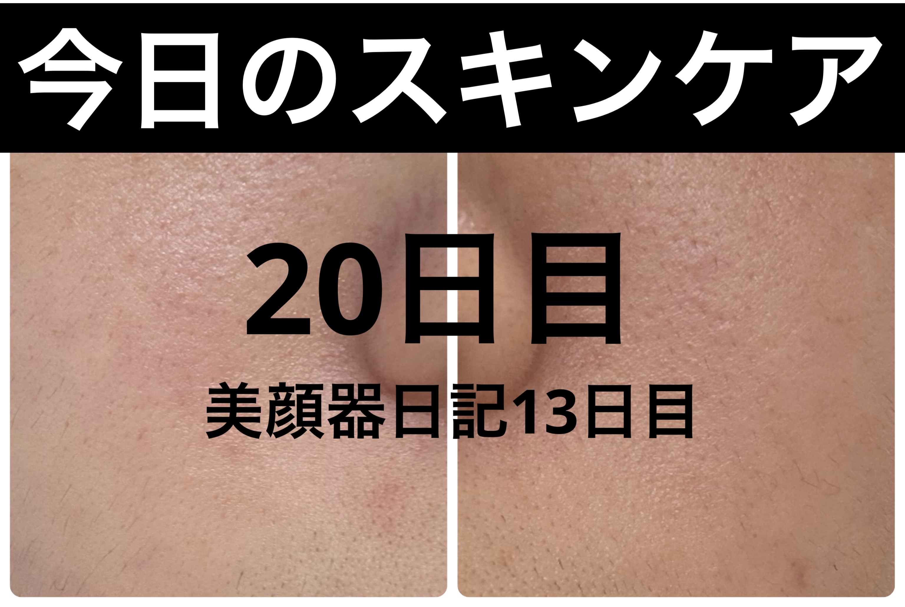 リュバンブラン エターナルアイクリームのクチコミ「【もぐもぐ日記20日目】
ニキビができないようにと注意していたにも関わらず、、、、🍪🍘🍦🍫
お.....」（1枚目）