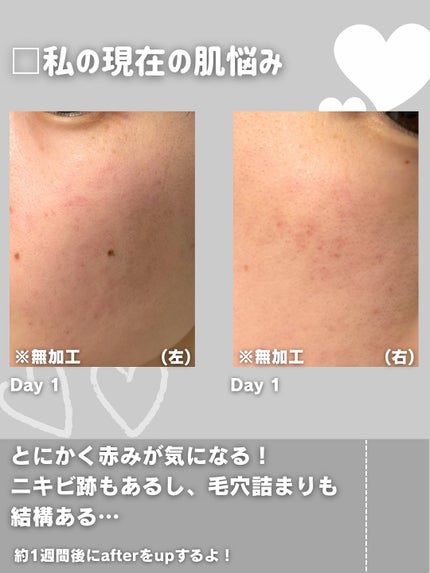 ダーマジェンシー ゼロカ81 クリーム/DERMAGENCY/フェイスクリームを使ったクチコミ(4枚目)