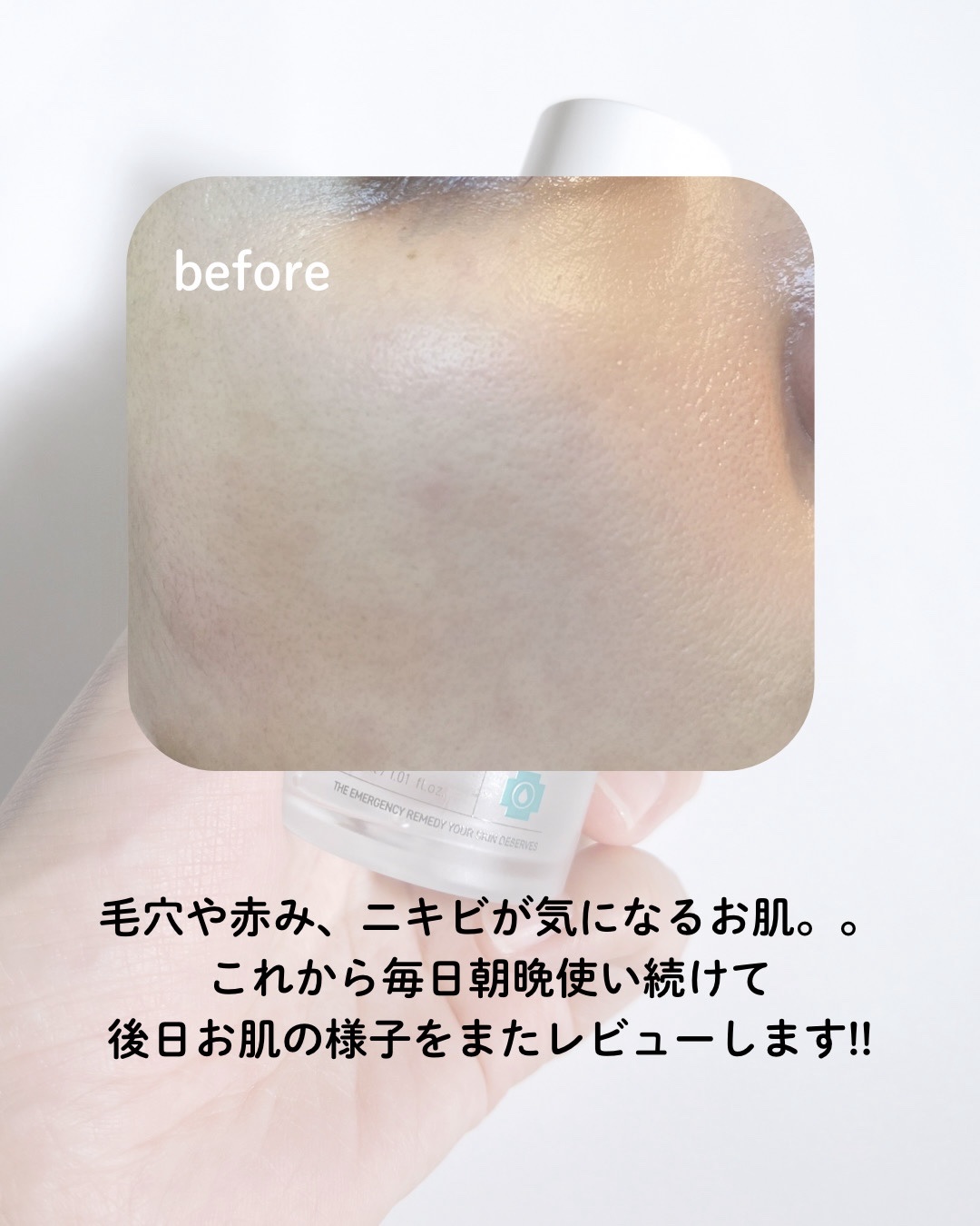 ダーマジェンシー ゼロカ81 セラム/DERMAGENCY/美容液を使ったクチコミ（3枚目）