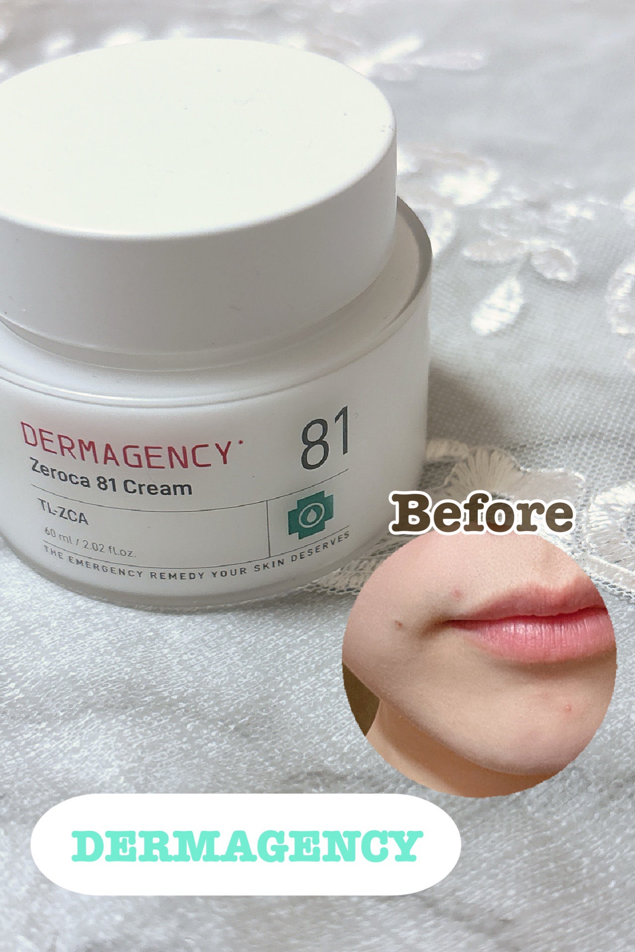 ダーマジェンシー ゼロカ81 クリーム/DERMAGENCY/フェイスクリームを使ったクチコミ(1枚目)