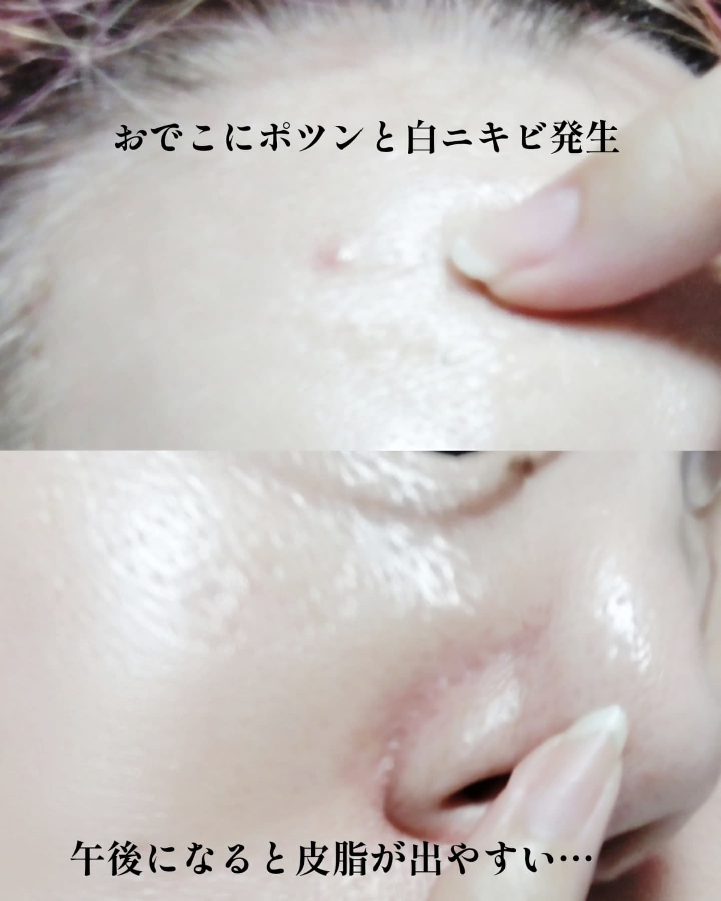 ダーマジェンシー ゼロカ86 トナー/DERMAGENCY/化粧水を使ったクチコミ（3枚目）