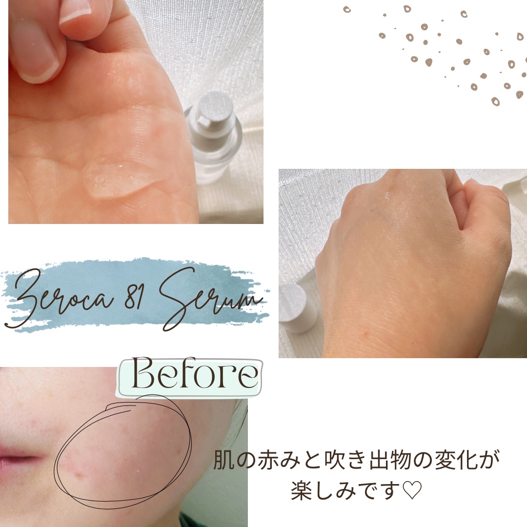 ダーマジェンシー ゼロカ81 セラム/DERMAGENCY/美容液を使ったクチコミ（2枚目）