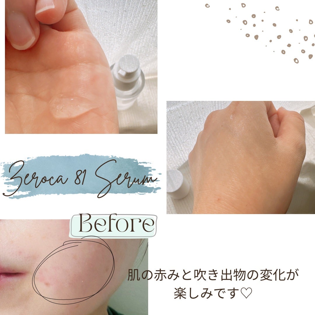ダーマジェンシー ゼロカ81 セラム/DERMAGENCY/美容液を使ったクチコミ(2枚目)
