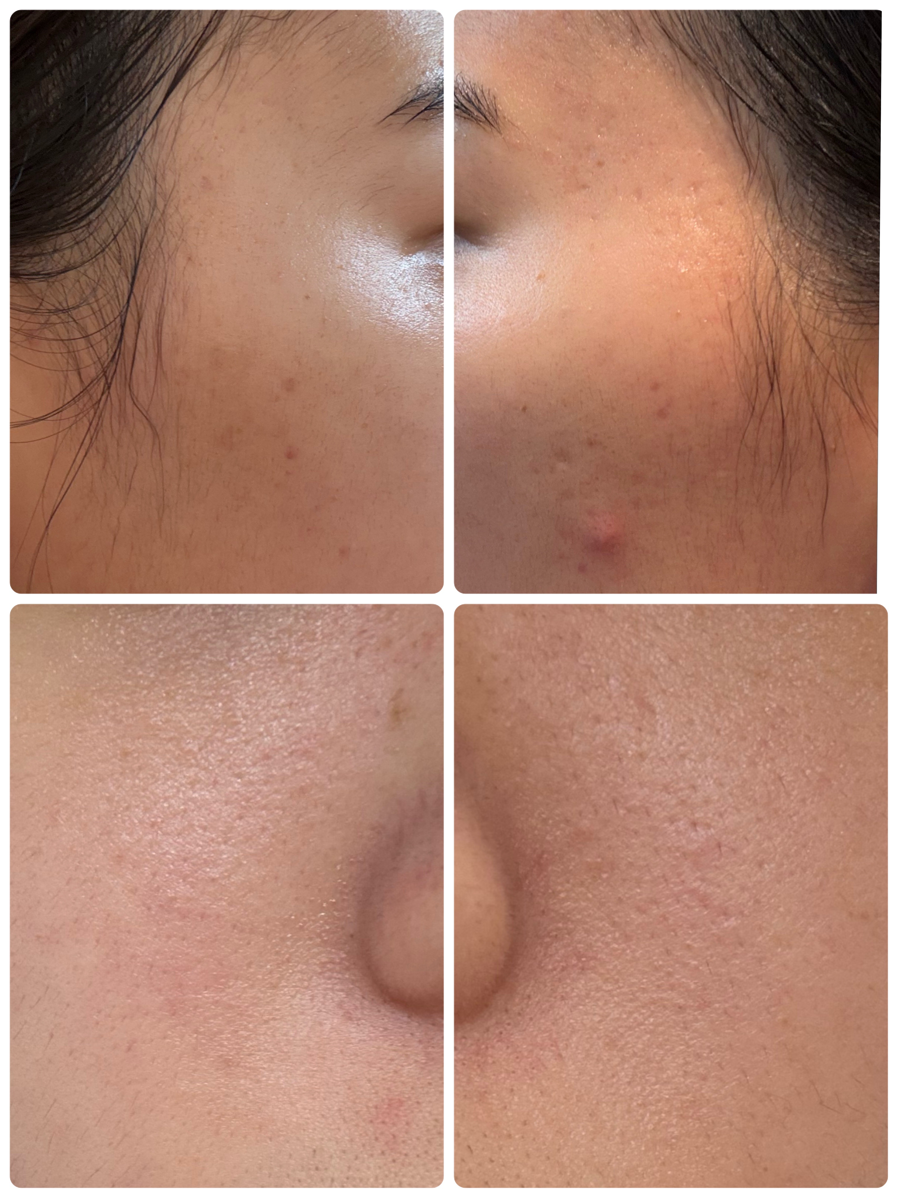 リュバンブラン エターナルアイクリームのクチコミ「【もぐもぐ日記20日目】
ニキビができないようにと注意していたにも関わらず、、、、🍪🍘🍦🍫
お.....」（2枚目）