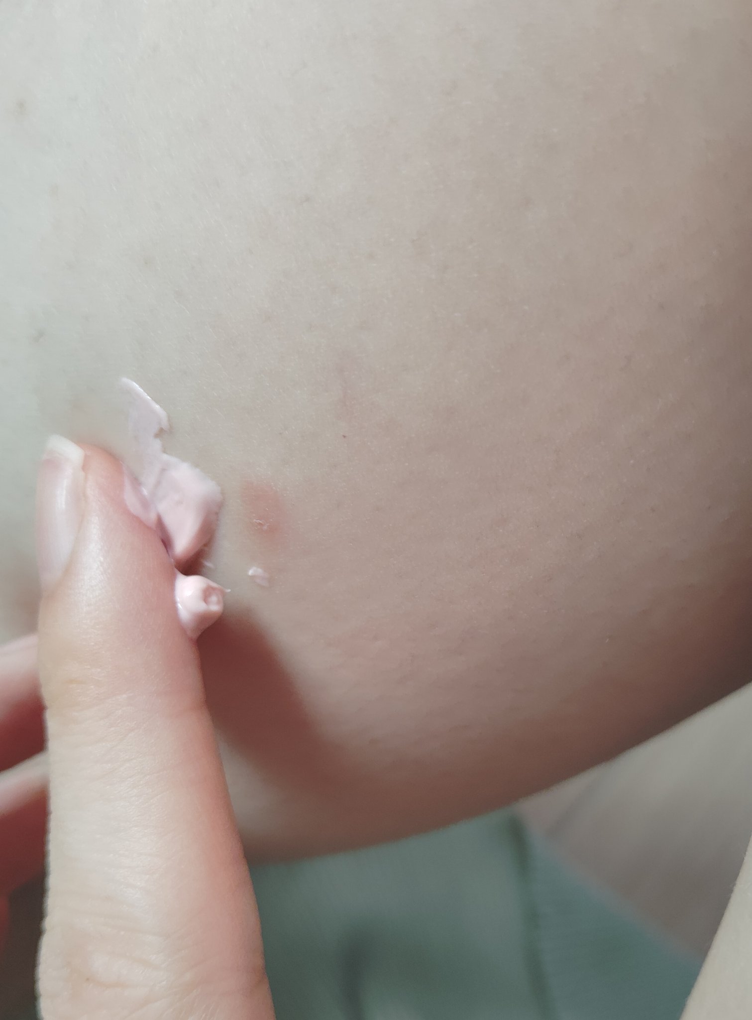 トフメルA（医薬品）/三宝製薬/その他を使ったクチコミ（2枚目）