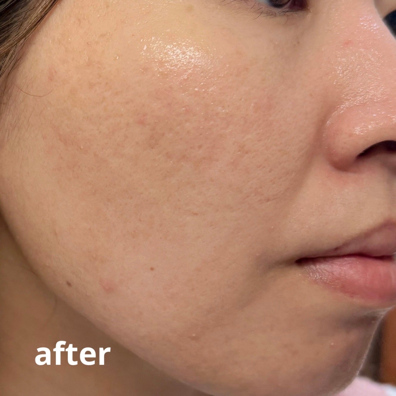 ダーマジェンシー ゼロカ81 セラム/DERMAGENCY/美容液を使ったクチコミ(7枚目)