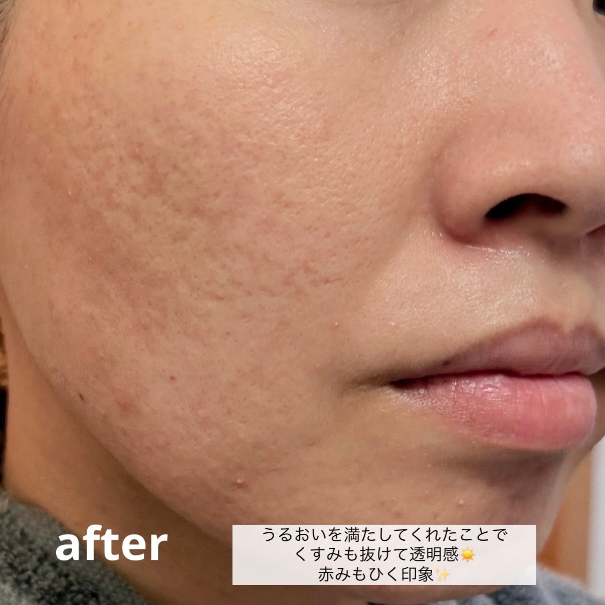 ダーマジェンシー ゼロカ86 トナー/DERMAGENCY/化粧水を使ったクチコミ(5枚目)