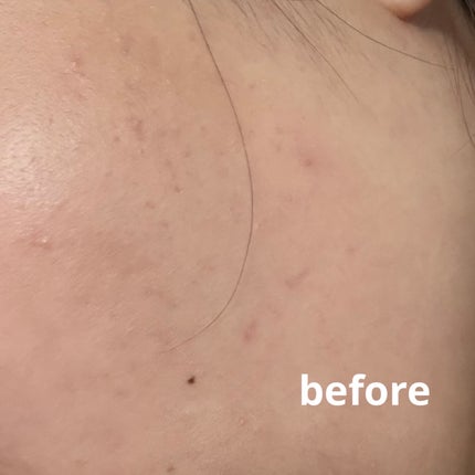 ダーマジェンシー ゼロカ81 クリーム/DERMAGENCY/フェイスクリームを使ったクチコミ(4枚目)