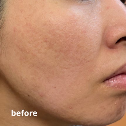 ダーマジェンシー ゼロカ81 セラム/DERMAGENCY/美容液を使ったクチコミ(6枚目)