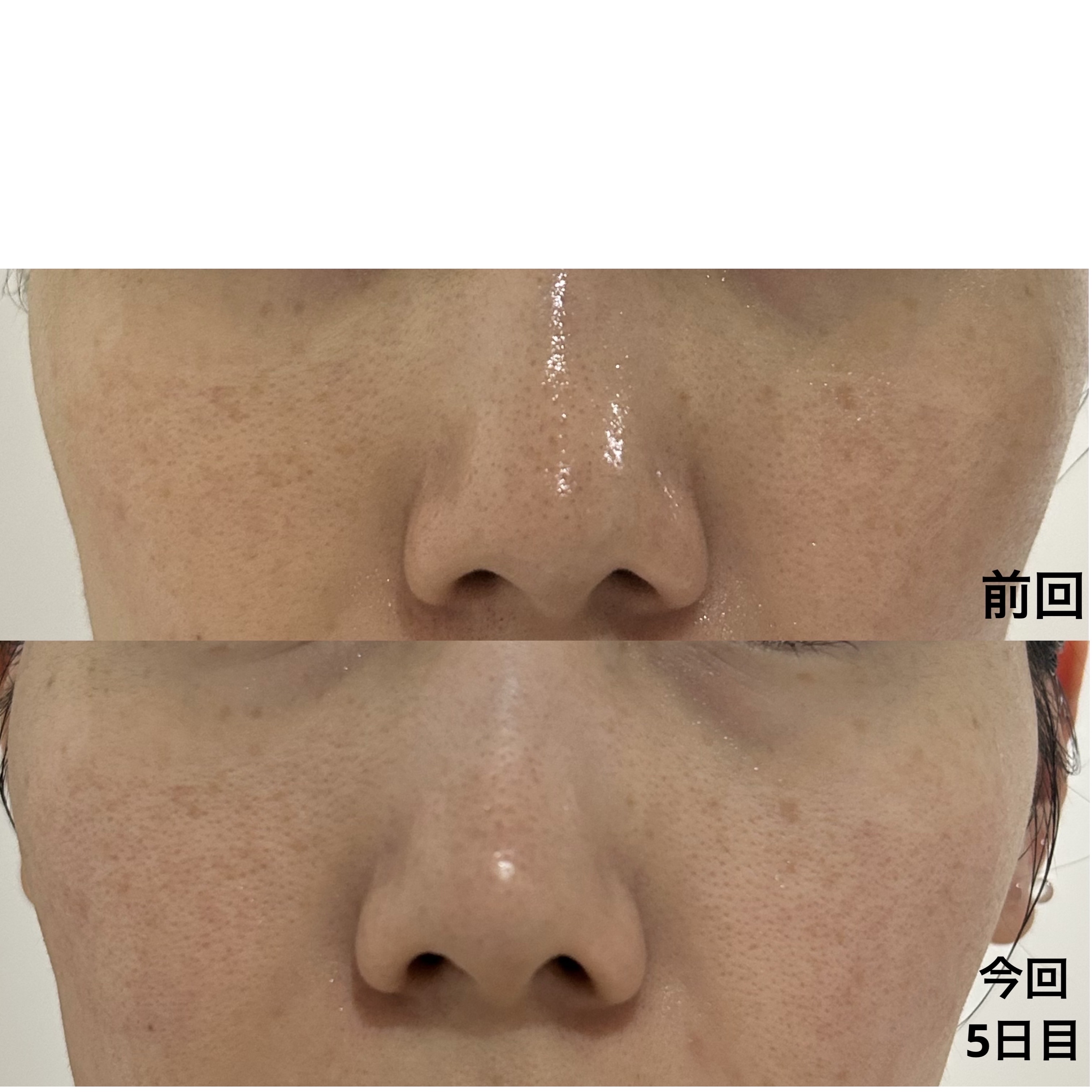 ⭐️ Yuu38⭐️ボタニカルピールレベル7 ボタニカルピールLevel_7<5回分>【パッケージリニューアル