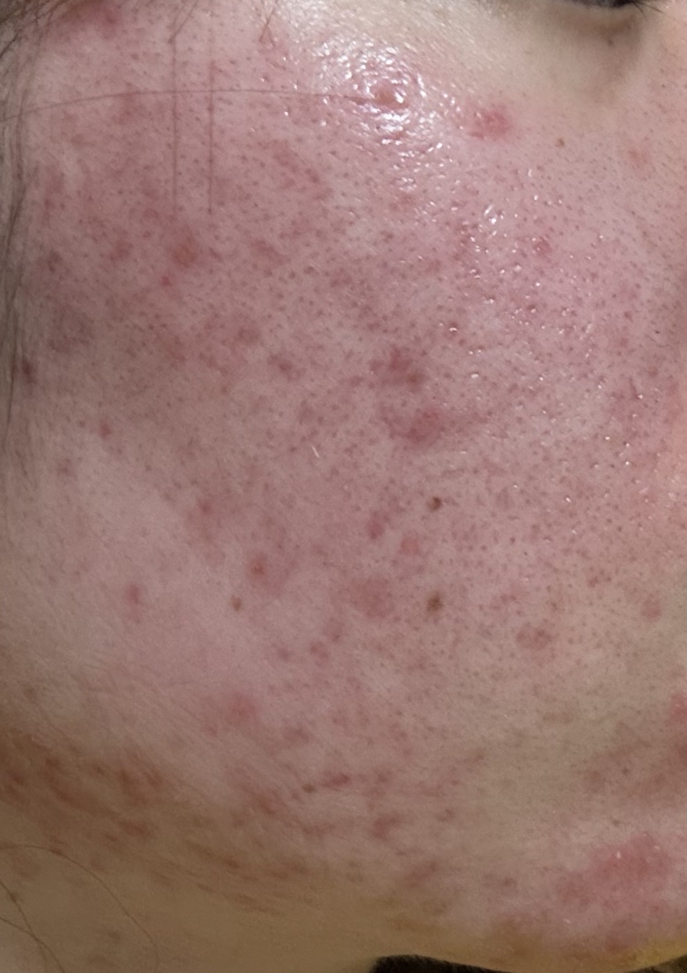 アヌア マイルドピーリングトナー/Anua/ピーリングを使ったクチコミ（3枚目）