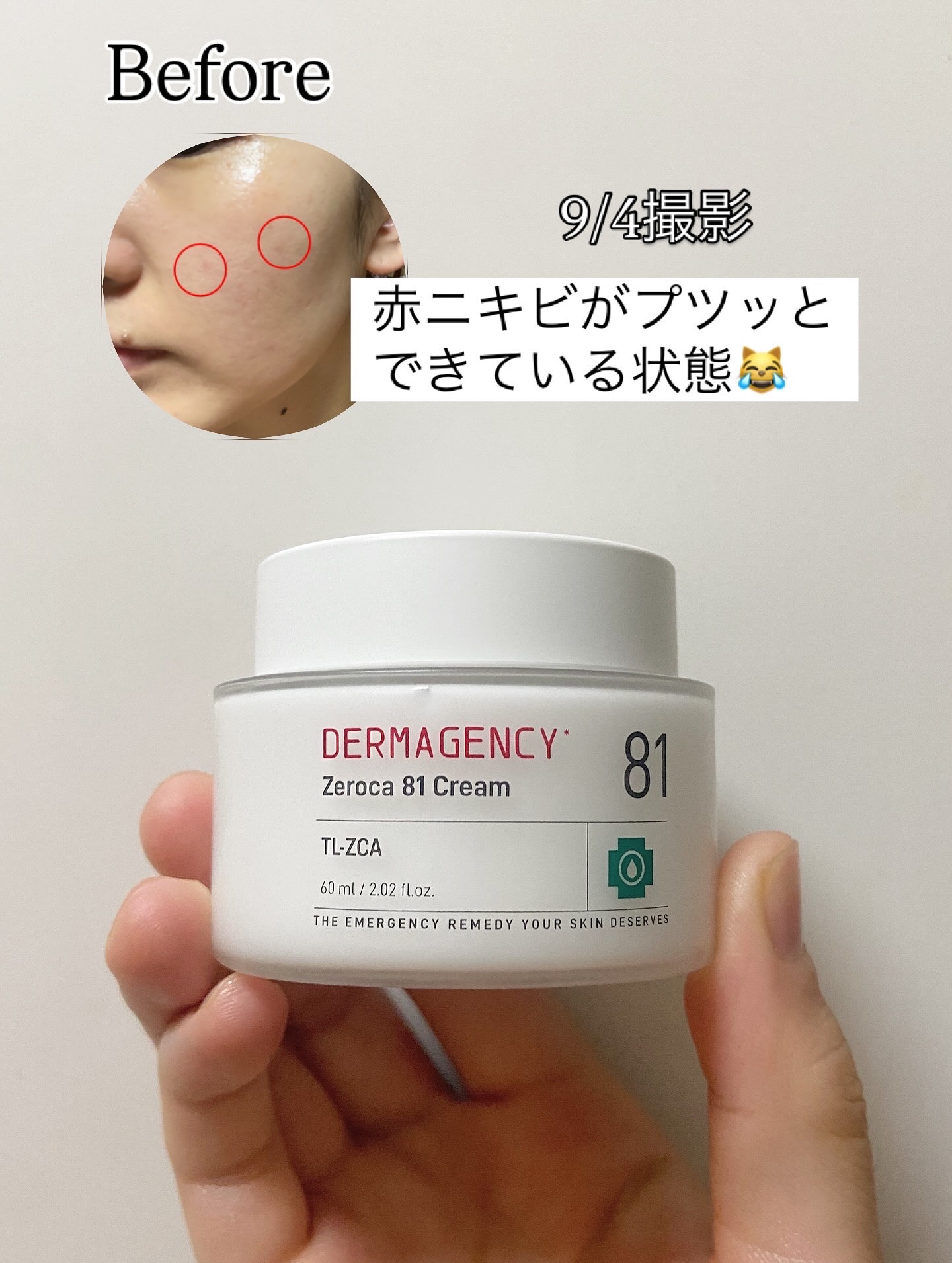 ダーマジェンシー ゼロカ81 クリーム/DERMAGENCY/フェイスクリームを使ったクチコミ（2枚目）