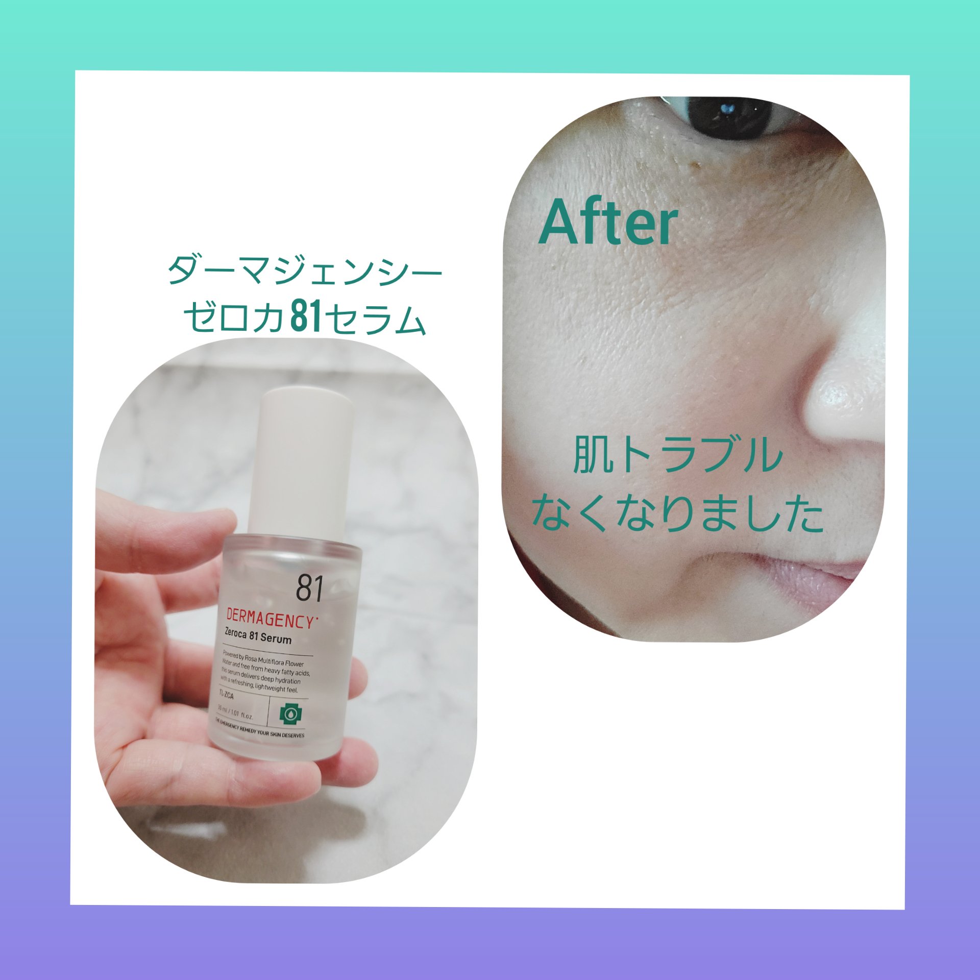 ダーマジェンシー ゼロカ81 セラム/DERMAGENCY/美容液を使ったクチコミ（3枚目）