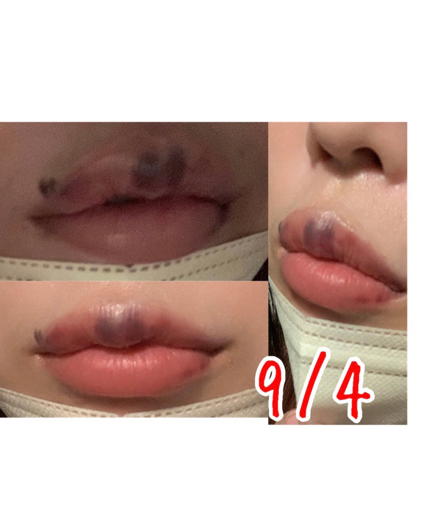 らん♥コスメ、シミケア観察 on LIPS 「ダウンタイムの経過を少し写真に撮ってたのでまとめてみました!C..」(3枚目)