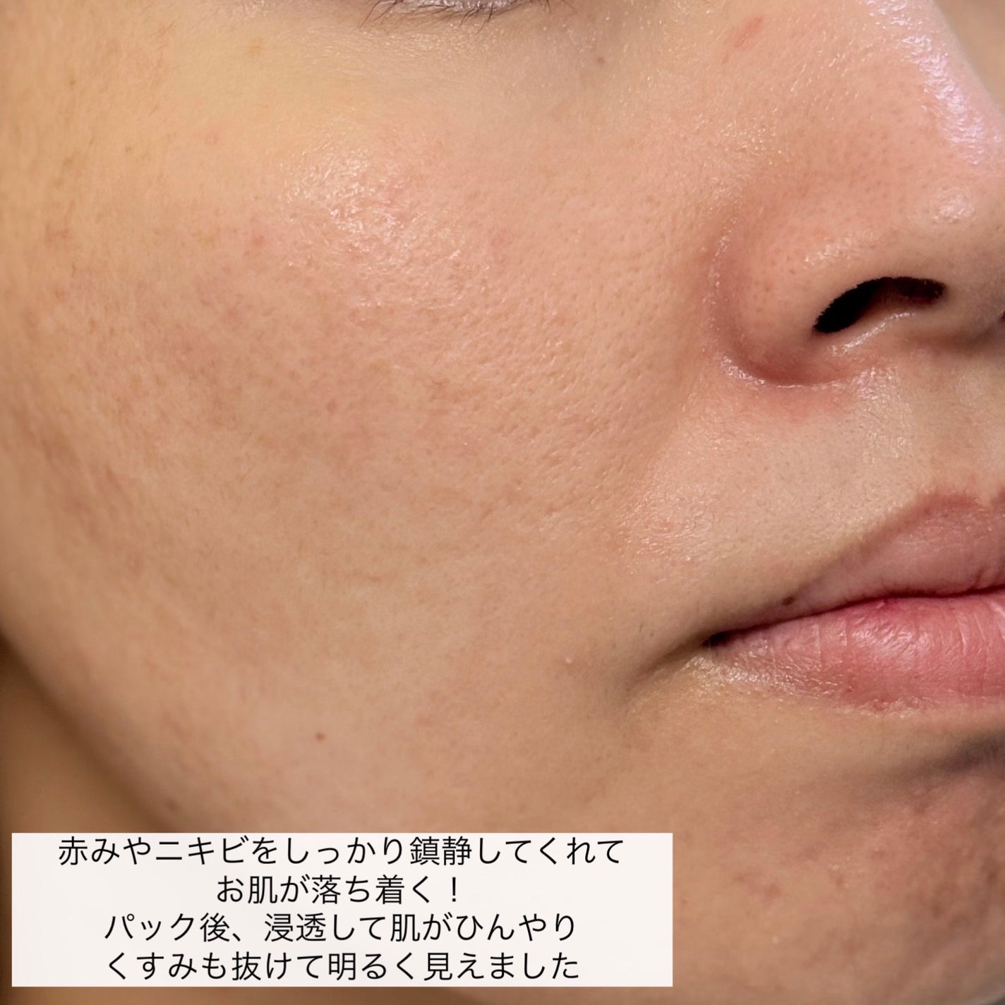 ティーツリーエッセンシャルマスク/MEDIHEAL/シートマスク・パックを使ったクチコミ(6枚目)