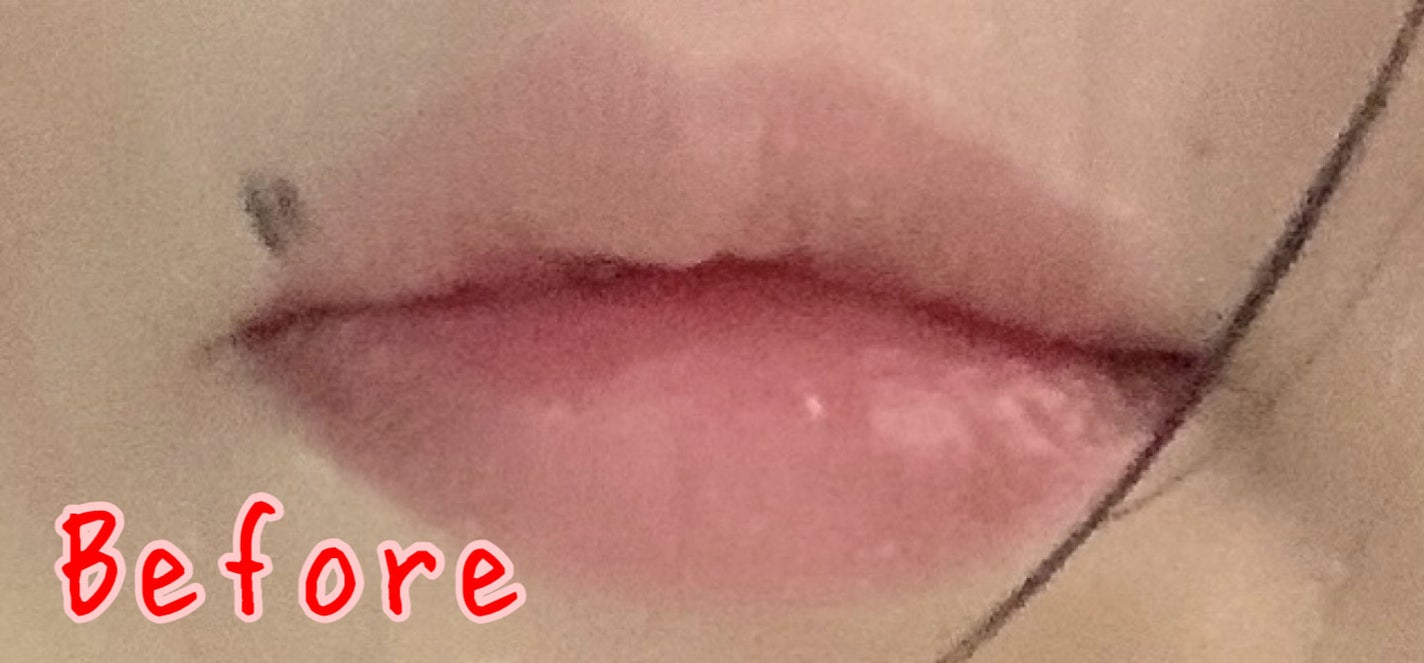 らん♥コスメ、シミケア観察 on LIPS 「ダウンタイムの経過を少し写真に撮ってたのでまとめてみました!C..」(2枚目)