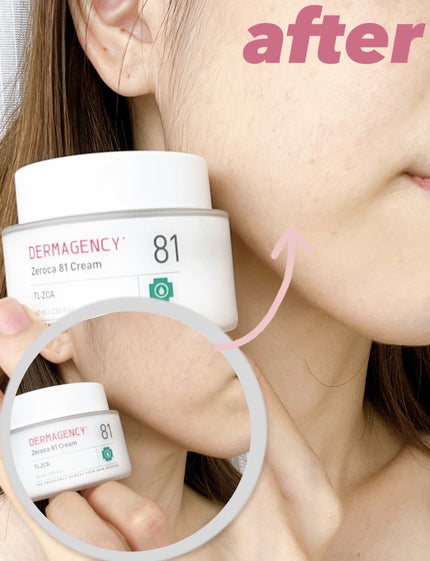 ダーマジェンシー ゼロカ81 クリーム/DERMAGENCY/フェイスクリームを使ったクチコミ(6枚目)