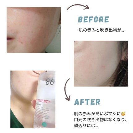 DERMAGENCY ダーマジェンシー ゼロカ86 トナーのクチコミ「#PR DERMAGENCY(@dermagency_jp)様
ゼロカ 86 トナー 200 .....」(2枚目)