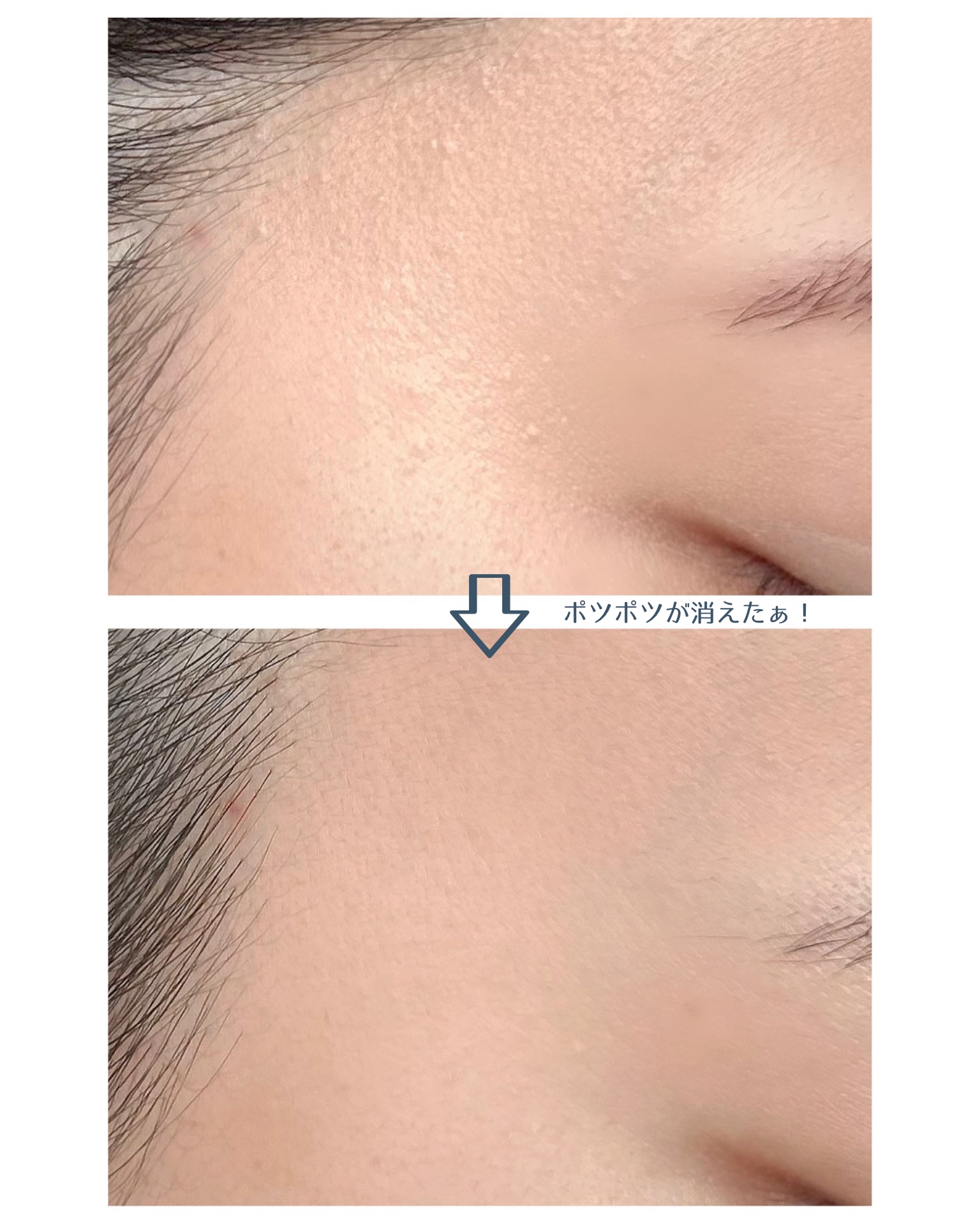 ダーマジェンシー ゼロカ81 クリーム/DERMAGENCY/フェイスクリームを使ったクチコミ（3枚目）