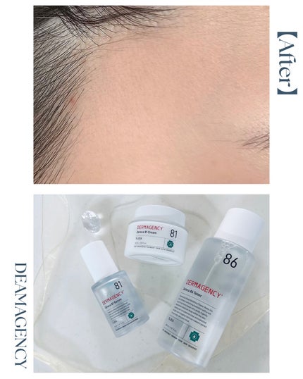 ダーマジェンシー ゼロカ81 クリーム/DERMAGENCY/フェイスクリームを使ったクチコミ(2枚目)