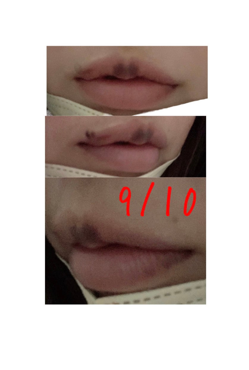 らん♥コスメ、シミケア観察 on LIPS 「ダウンタイムの経過を少し写真に撮ってたのでまとめてみました!C..」(5枚目)