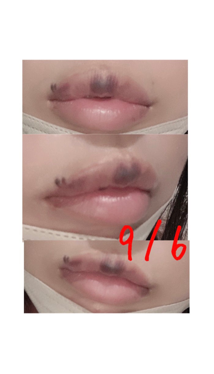 らん♥コスメ、シミケア観察 on LIPS 「ダウンタイムの経過を少し写真に撮ってたのでまとめてみました!C..」(4枚目)