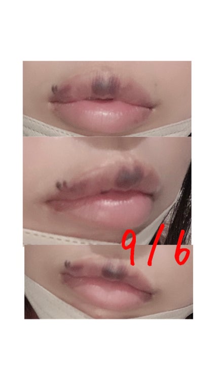 らん♥コスメ、シミケア観察 on LIPS 「ダウンタイムの経過を少し写真に撮ってたのでまとめてみました!C..」(4枚目)