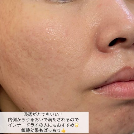 マデカッソシド エッセンシャルマスク/MEDIHEAL/シートマスク・パックを使ったクチコミ(6枚目)