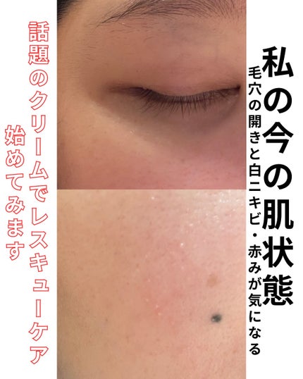 ダーマジェンシー ゼロカ81 クリーム/DERMAGENCY/フェイスクリームを使ったクチコミ(3枚目)