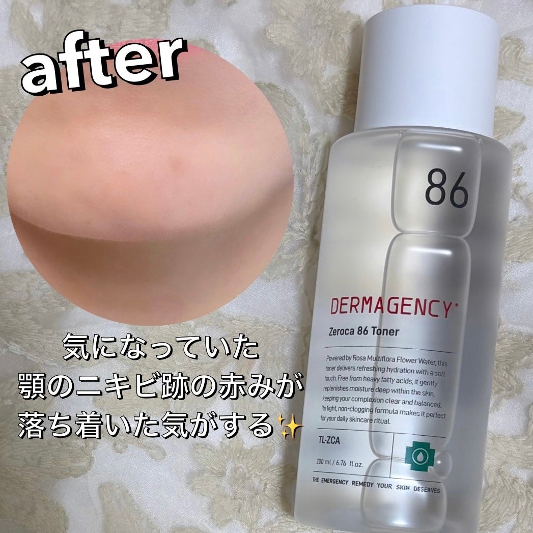 ダーマジェンシー ゼロカ86 トナー/DERMAGENCY/化粧水を使ったクチコミ(3枚目)