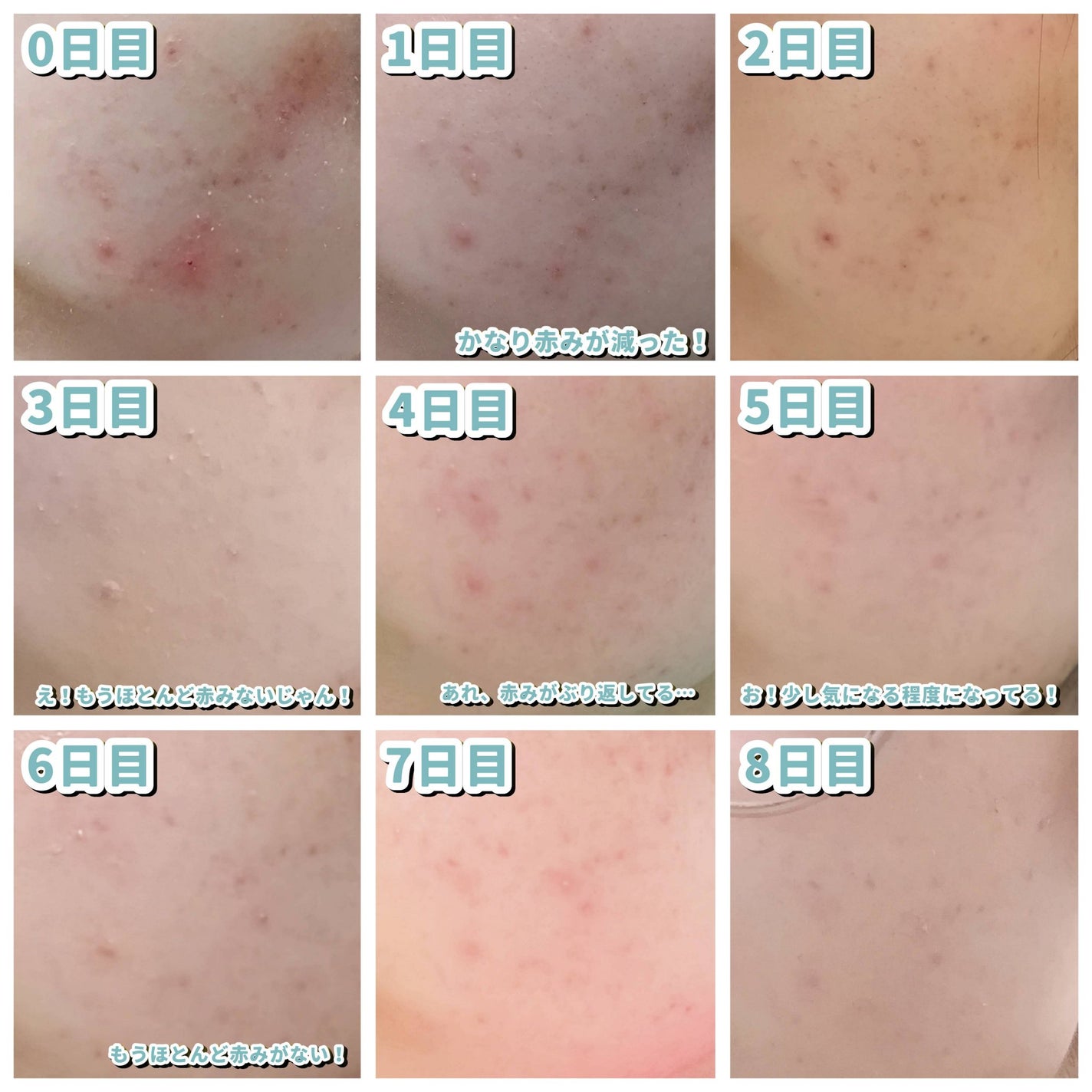 FEG アゼライン酸 15%配合 クリアスキンクリームA /FEG/フェイスクリームを使ったクチコミ(2枚目)