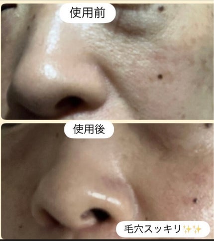 弱酸性毛穴収縮ニドソープ/ODELOI/その他洗顔料を使ったクチコミ(5枚目)