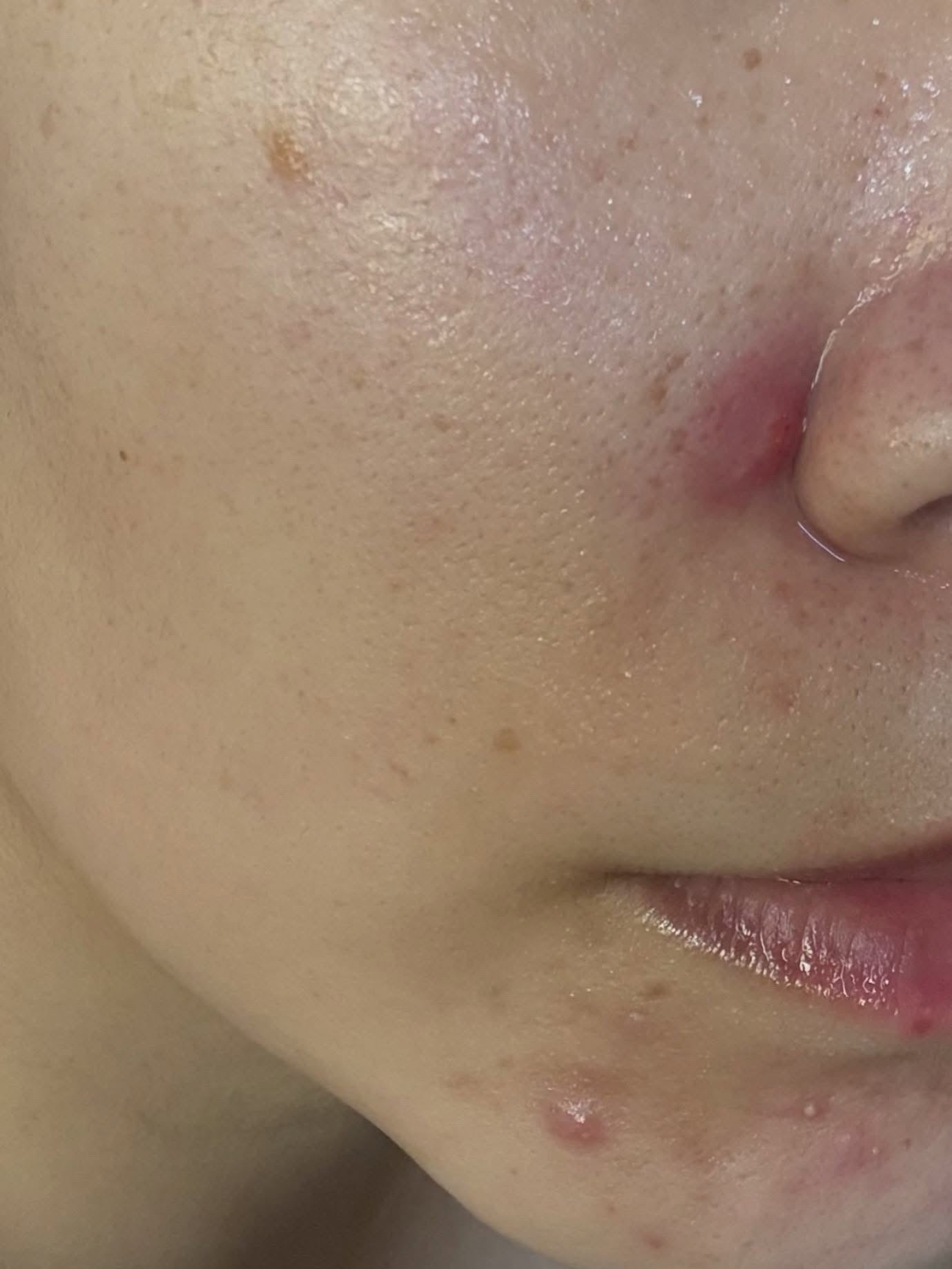 ダーマジェンシー ゼロカ81 セラム/DERMAGENCY/美容液を使ったクチコミ(5枚目)