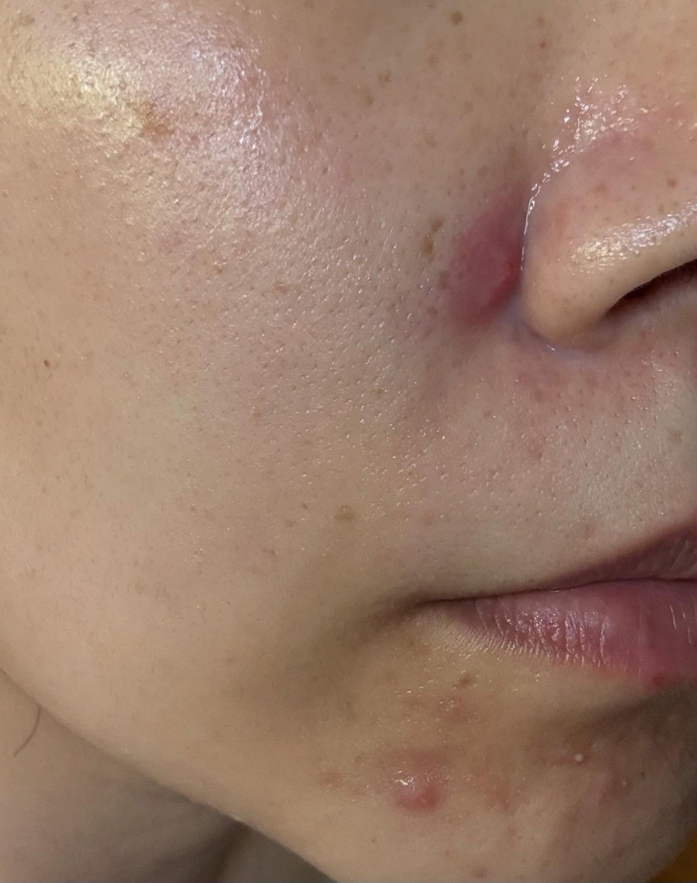 ダーマジェンシー ゼロカ81 クリーム/DERMAGENCY/フェイスクリームを使ったクチコミ(7枚目)